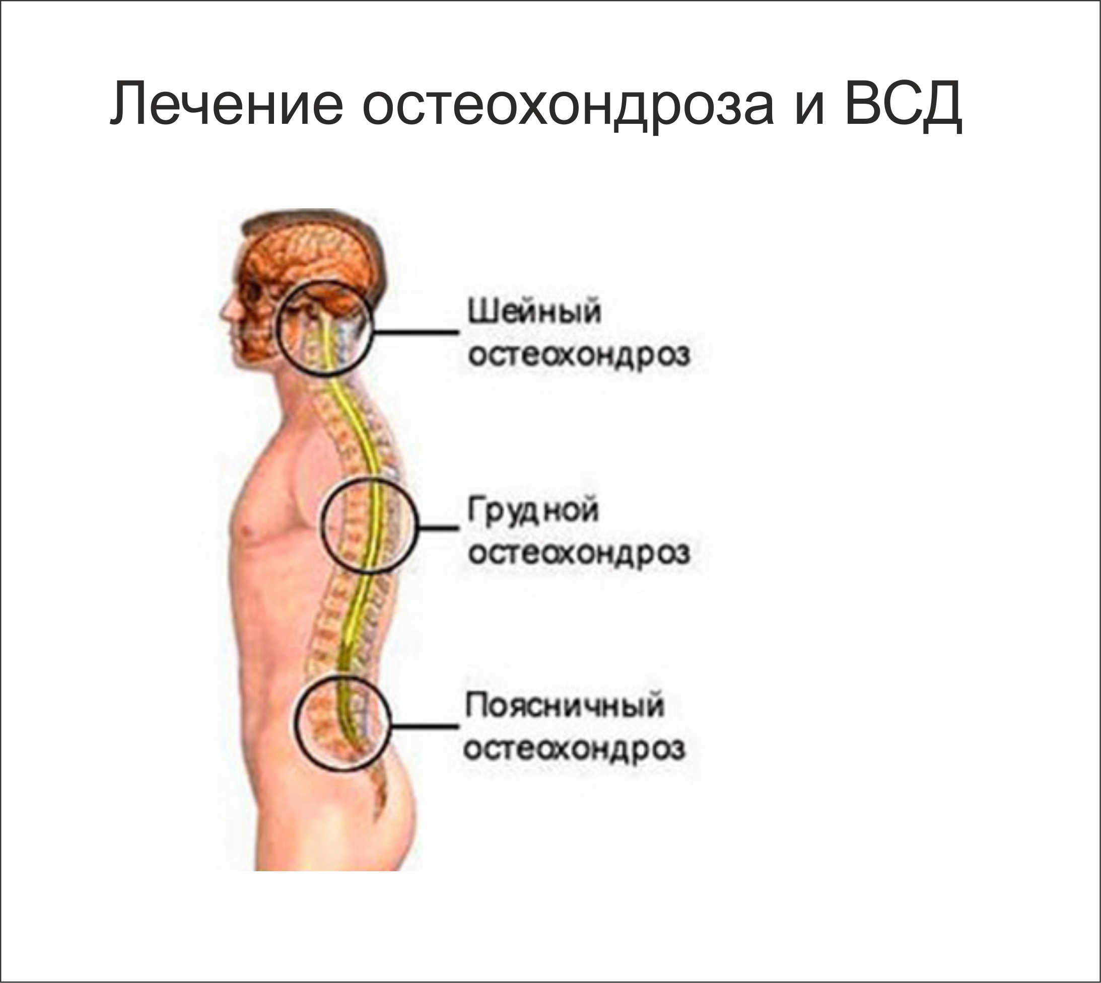 Как лечить грудной остеохондроз в домашних условиях Как лечить грудной остеохондроз в домашних условиях
